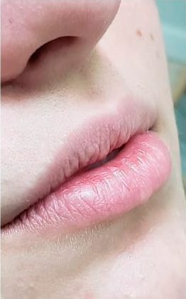 preenchimento-labial-antes