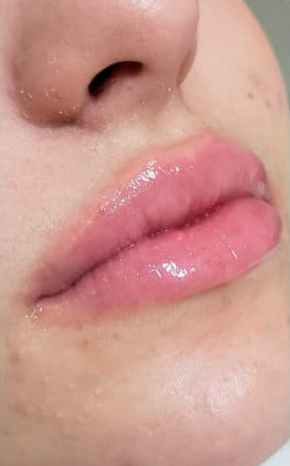 preenchimento-labial-depois