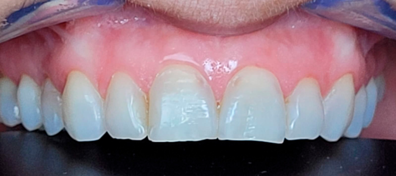 recontorno-estético-em-resina-antes