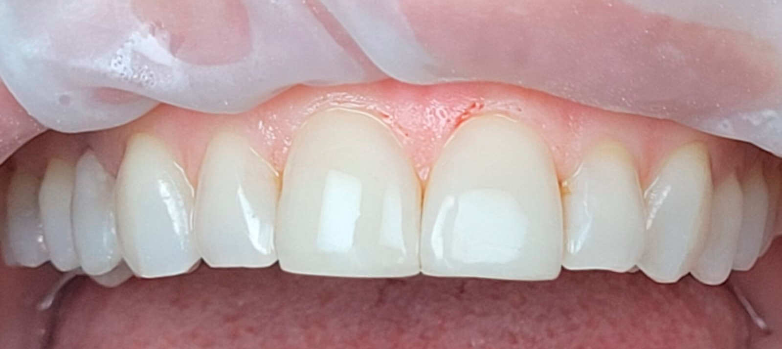 recontorno-estético-em-resina-depois